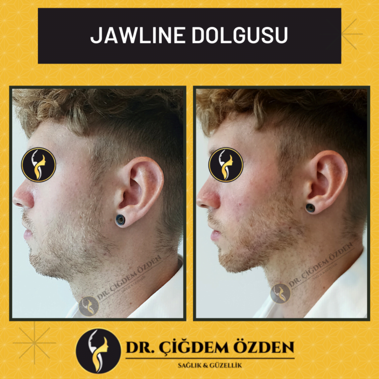 jawline-dolgusu-istanbul