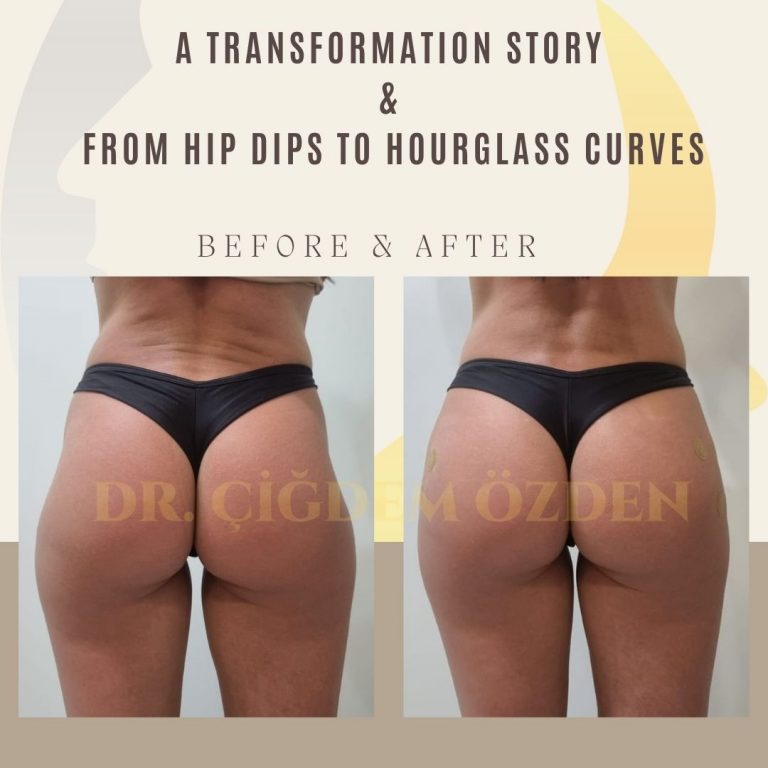 Hip Dip Filler: What Results to Expect After the Treatment?