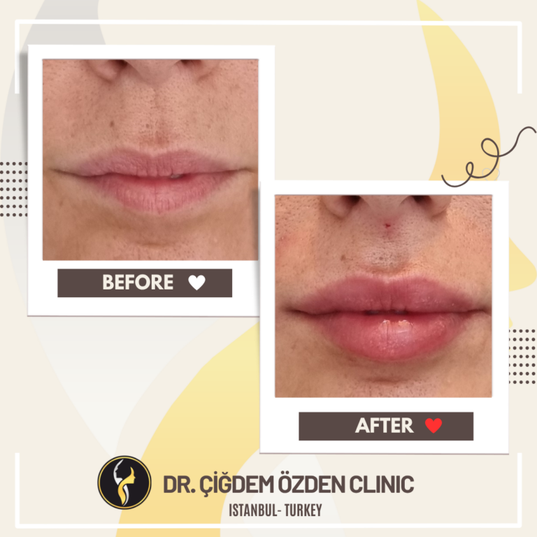 lip-filler-before-after-4